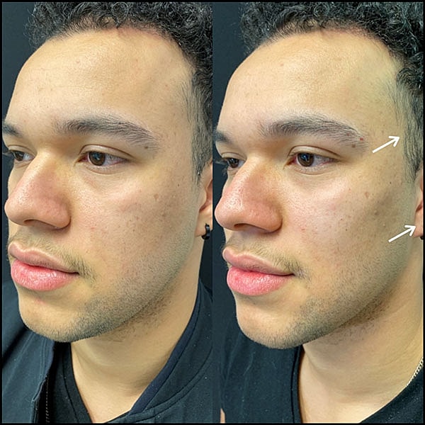 Juvederm Before & After
