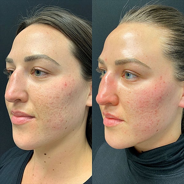 Juvederm Before & After