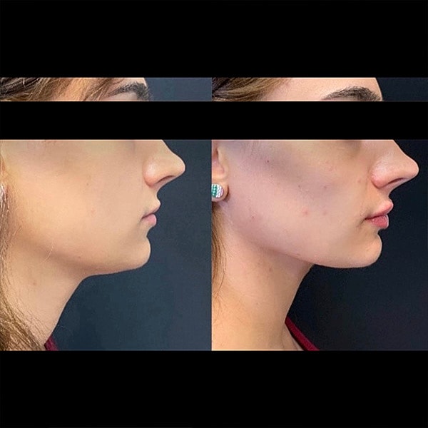 Juvederm Before & After