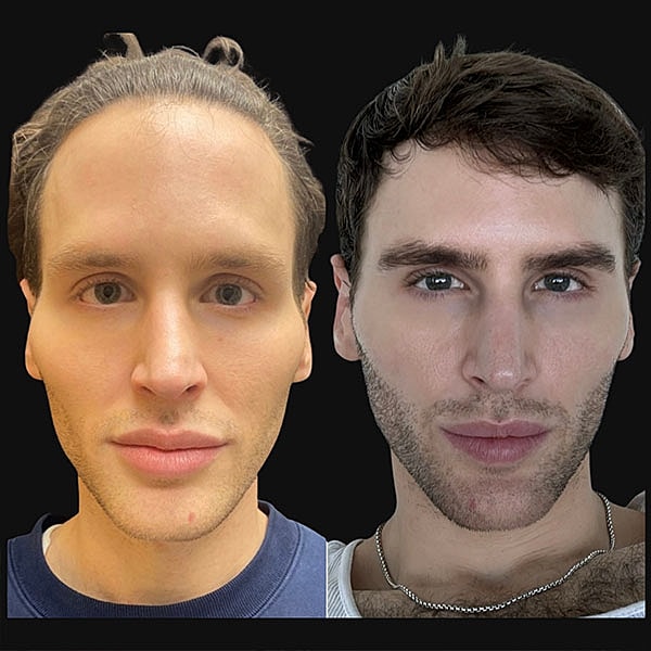 Juvederm Before & After