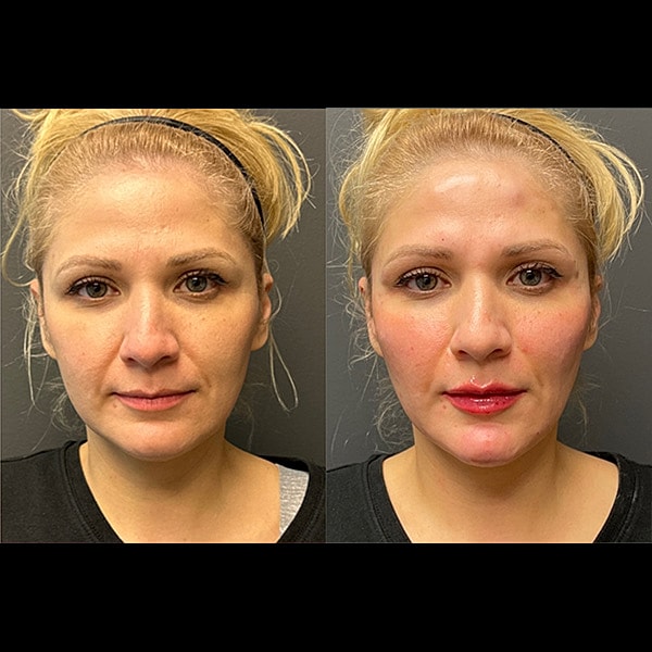 Juvederm Before & After