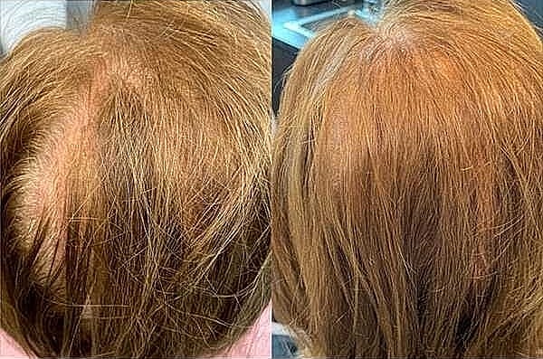 Hair Rejuvenation Before & After