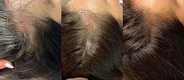 Hair Rejuvenation Before & After