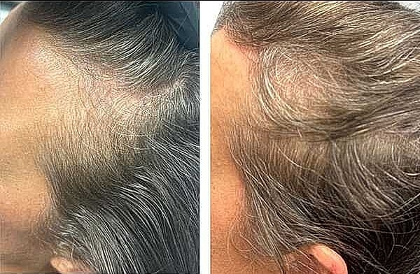 Hair Rejuvenation Before & After