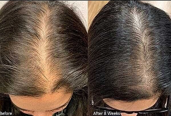 Hair Rejuvenation Before & After