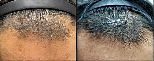 Hair Rejuvenation Before & After