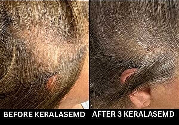 Hair Rejuvenation Before & After