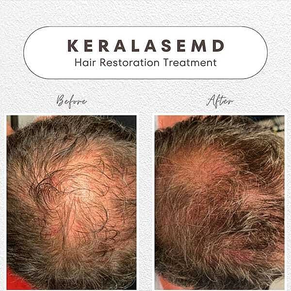 Hair Rejuvenation Before & After