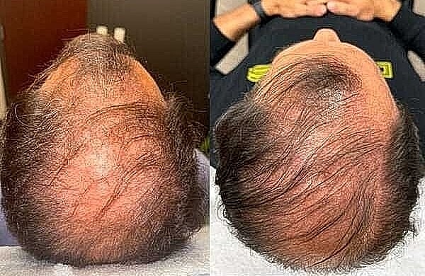 Hair Rejuvenation Before & After