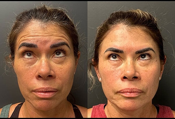 Neuromodulators Before & After