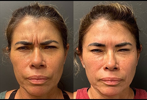 Neuromodulators Before & After