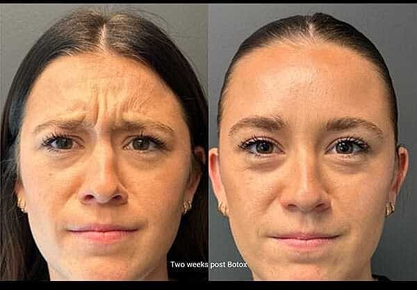 Neuromodulators Before & After