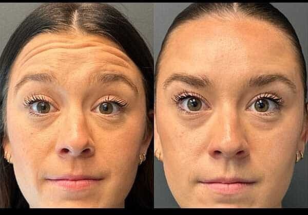 Neuromodulators Before & After