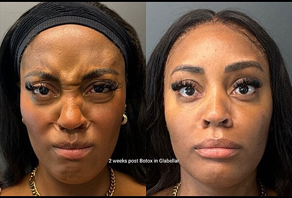 Neuromodulators Before & After