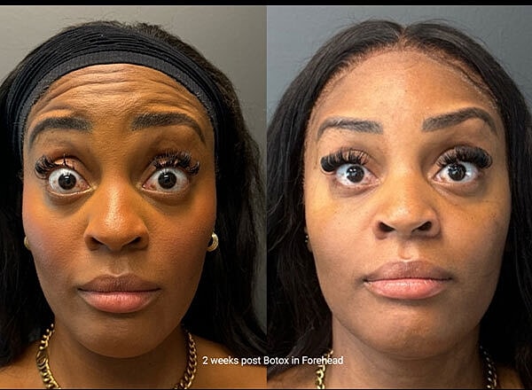 Neuromodulators Before & After