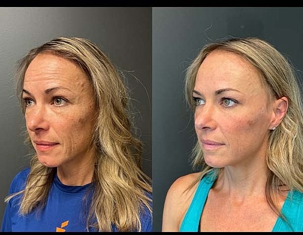Neuromodulators Before & After