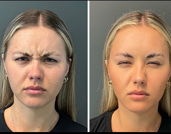 Neuromodulators Before & After