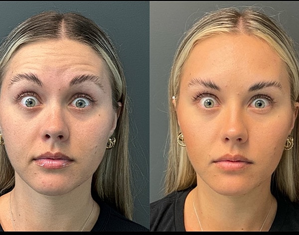 Neuromodulators Before & After