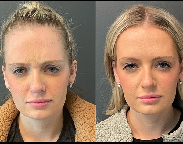 Neuromodulators Before & After