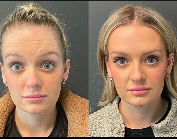 Neuromodulators Before & After