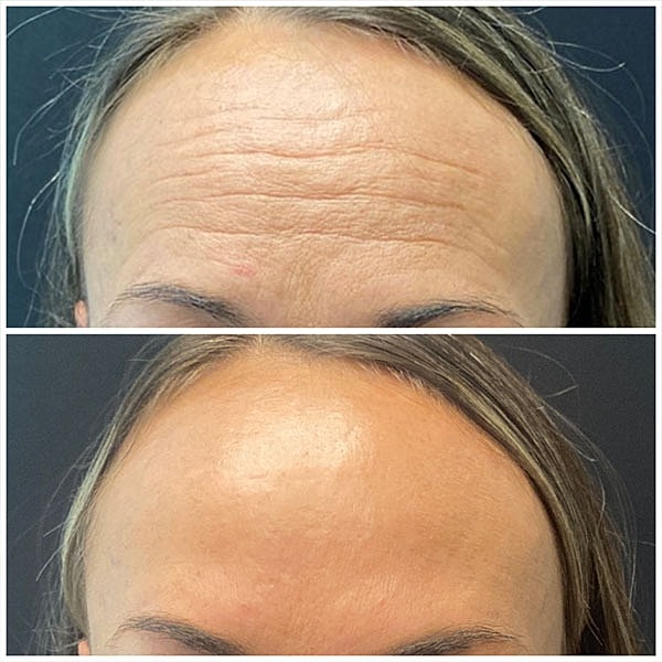 Neuromodulators Before & After