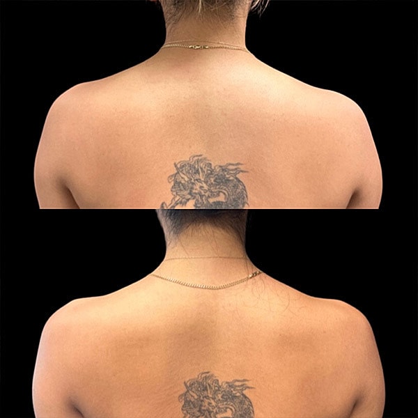 Neuromodulators Before & After