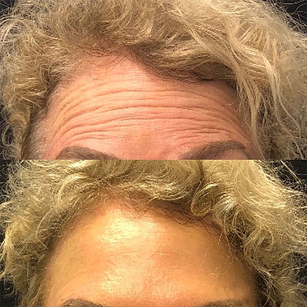 Neuromodulators Before & After