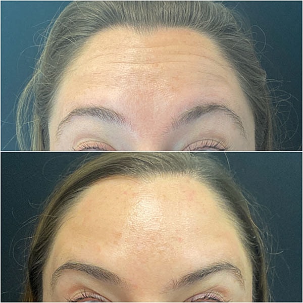 Neuromodulators Before & After