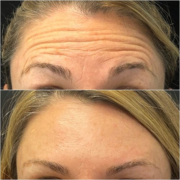Neuromodulators Before & After