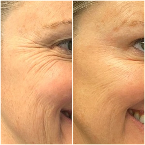 Neuromodulators Before & After