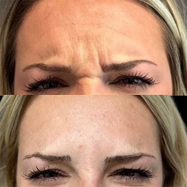 Neuromodulators Before & After