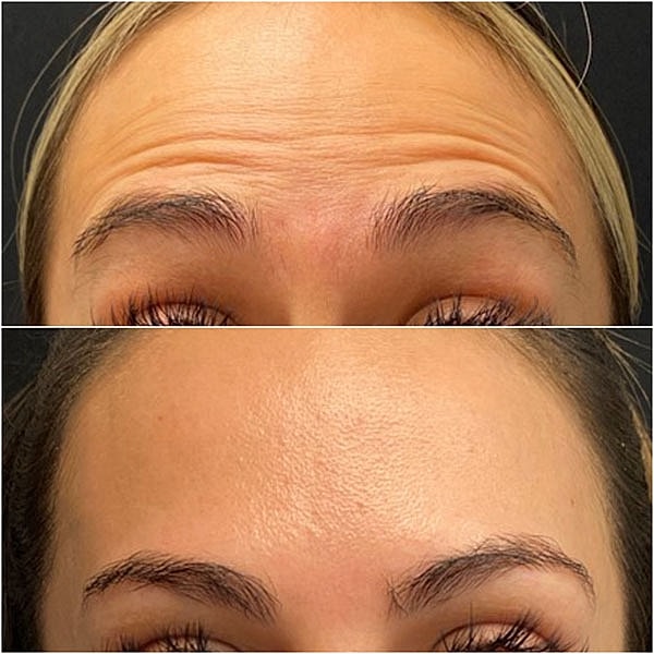 Neuromodulators Before & After