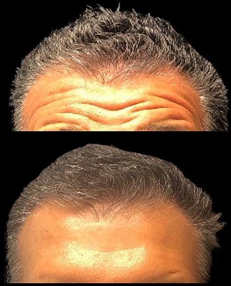 Neuromodulators Before & After