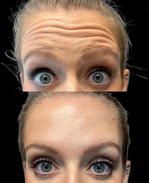 Neuromodulators Before & After