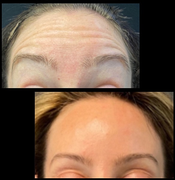 Neuromodulators Before & After
