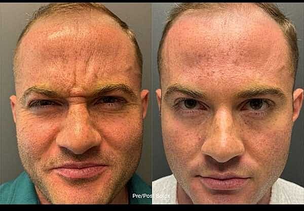 Neuromodulators Before & After