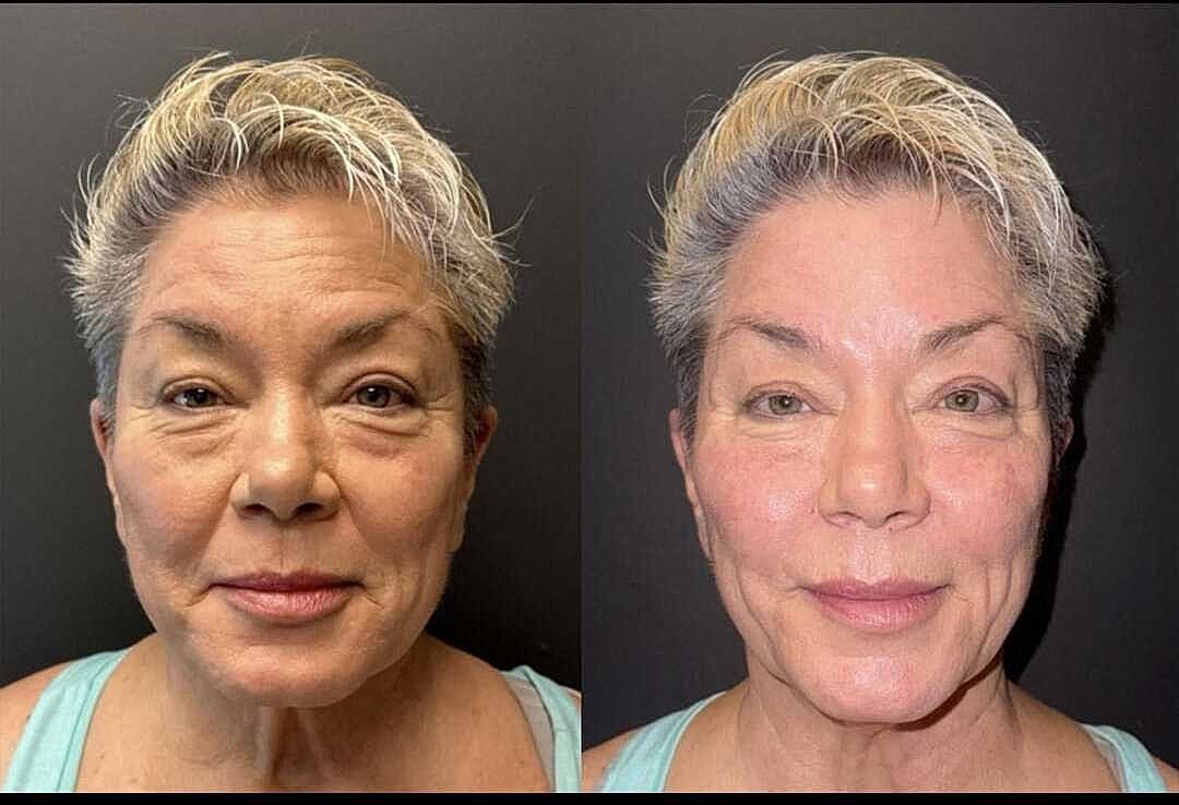 Dermal Fillers Before & After