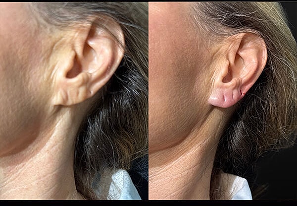 Dermal Fillers Before & After