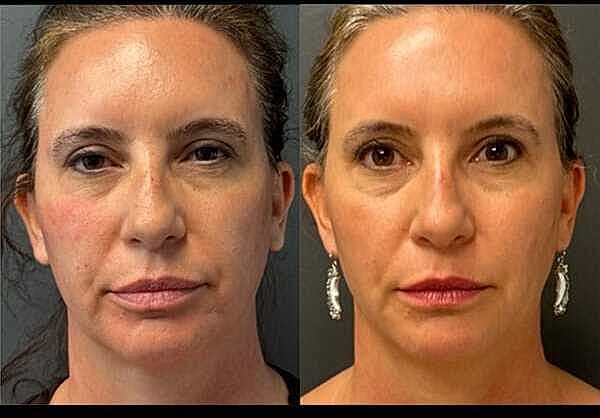 Dermal Fillers Before & After