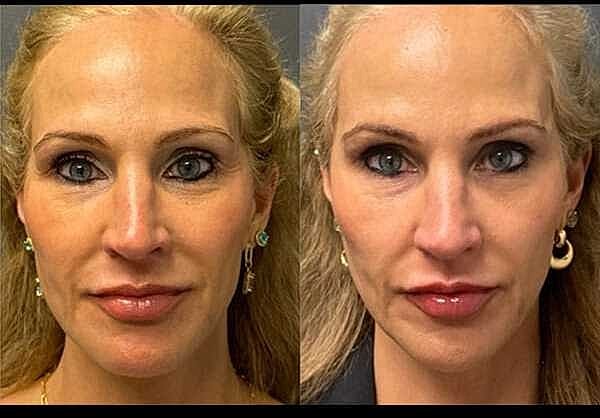 Dermal Fillers Before & After
