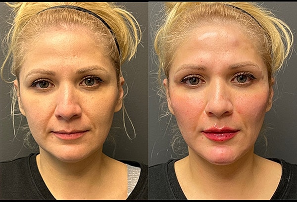 Dermal Fillers Before & After