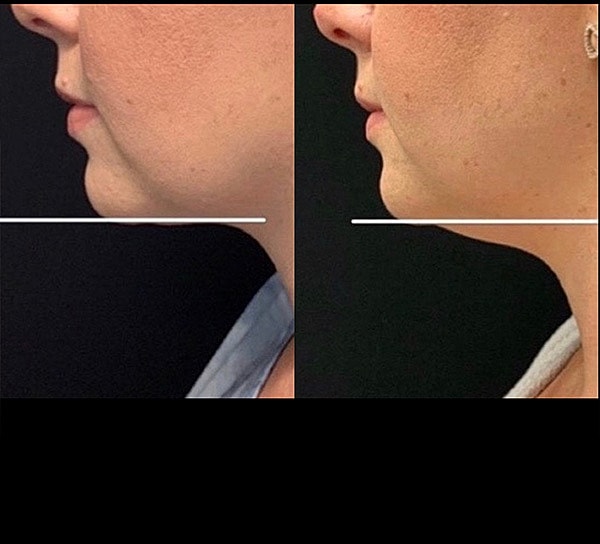 Dermal Fillers Before & After