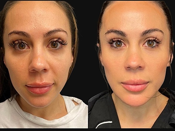 Dermal Fillers Before & After