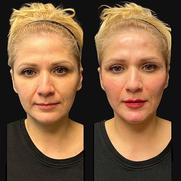 Dermal Fillers Before & After