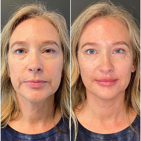 Dermal Fillers Before & After