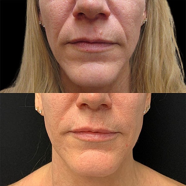 Dermal Fillers Before & After