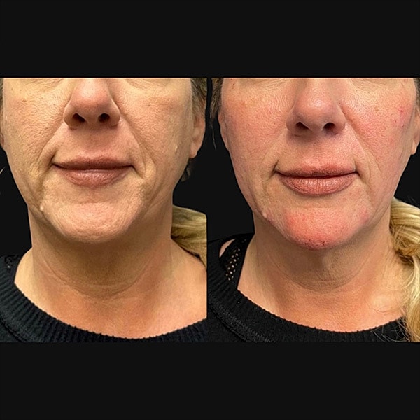 Dermal Fillers Before & After