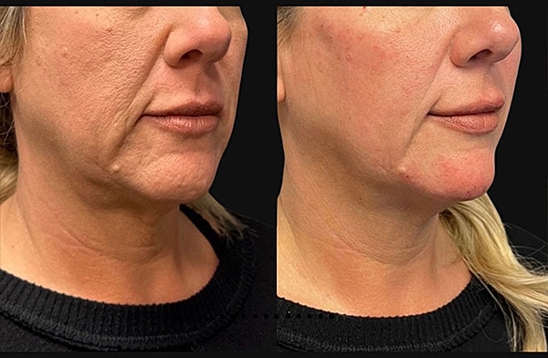 Dermal Fillers Before & After