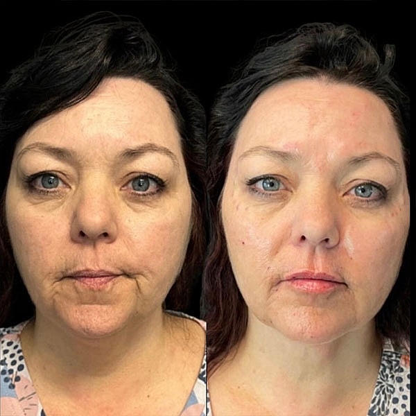 Dermal Fillers Before & After