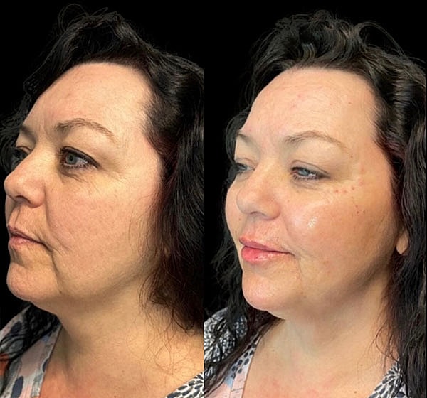 Dermal Fillers Before & After